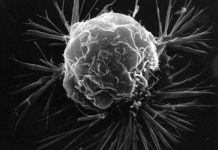 Bestimmte Bakteriengifte im Tumor können die Körperabwehr stimulieren, so dass sie den Krebs angreift. Foto: Wikimedia Commons