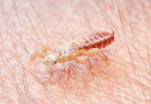 Lästig, aber harmlos: Läuse-Alarm in Schulen oder Kitas ist meistens unnötig