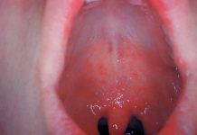 Die typischen Symptome der Masern sind neben Hautausschlag auch Fieber, Husten, Schnupfen und Entzündungen der Schleimhäute. Foto: Steffen Bernard / Wikimedia Commons