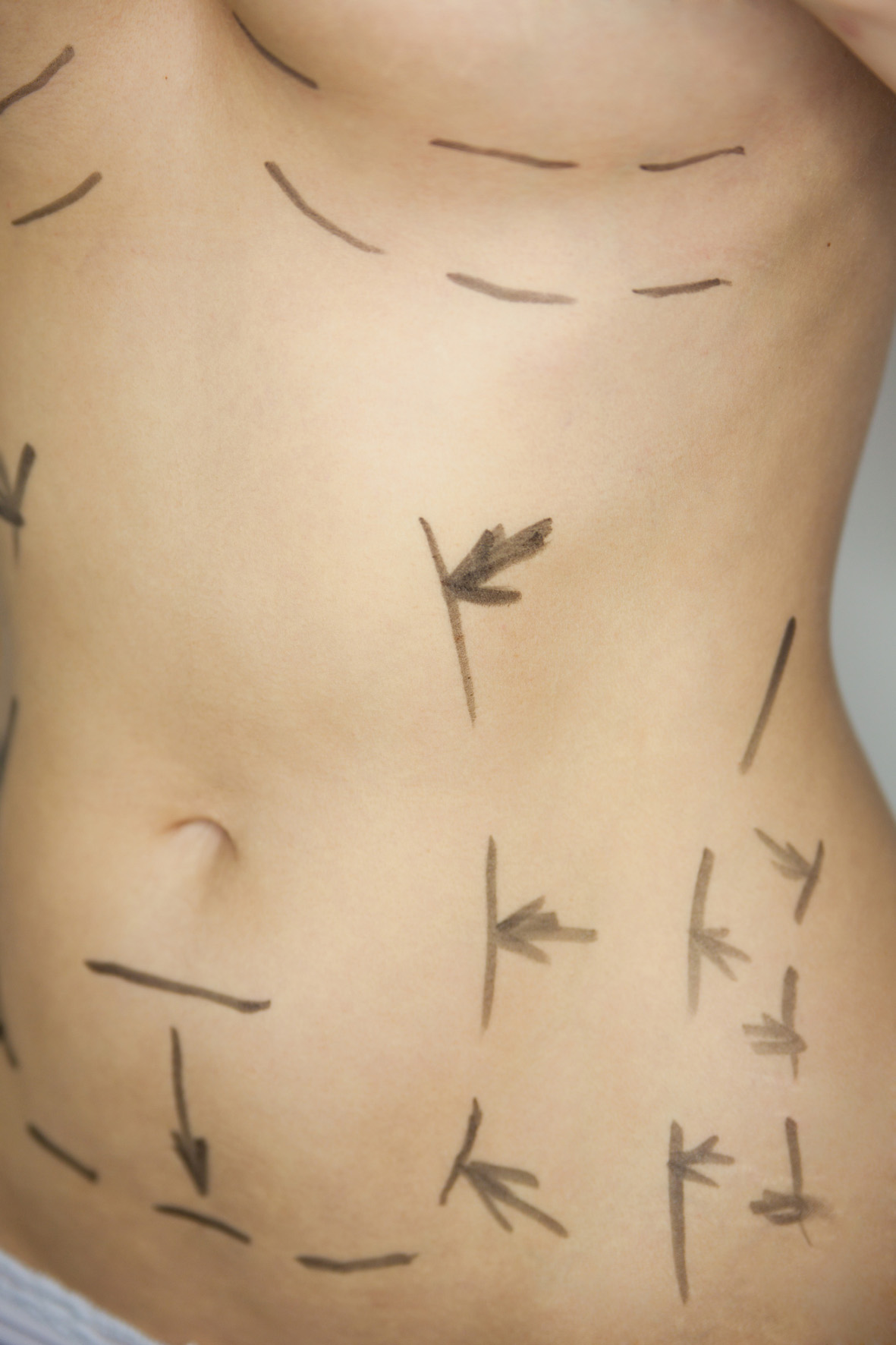 Für eine Fettabsaugung werden etwa so die betroffenen Regionen markiert (Foto: LBS/Fotolia)