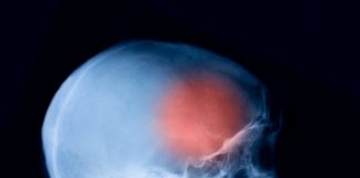 Grundschüler stirbt an Meningokokken-Infektion – Kontaktpersonen in Behandlung