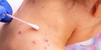 Windpocken-Ausbruch an Rudolf-Steiner-Schule – mehr als 20 Kinder betroffen